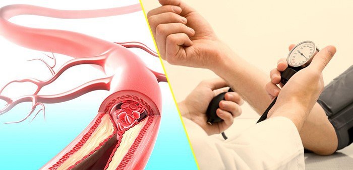 Biến chứng cao huyết áp và giải pháp từ Motarin 6 Các biến chứng nguy hiểm của cao huyết áp